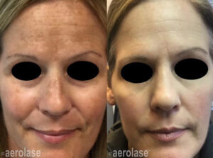 Aerolase Neo Elite Evansville Petersburg Haubstadt Oakland City Fairfield Princeton IN