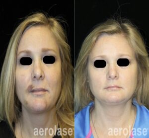 Aerolase Neo Elite Evansville Petersburg Haubstadt Oakland City Fairfield Princeton IN Fort Branch Poseyville